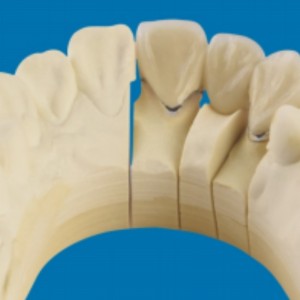 Metalli-posliinihampaat